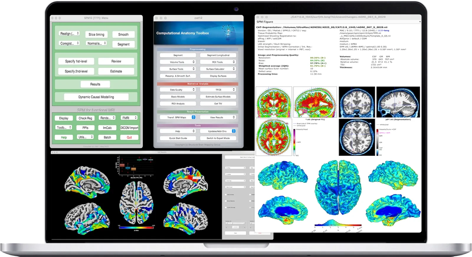 CAT running in SPM: the CAT menu, a single-subject report with quality ratings and tissue segmentation, and cortical thickness results on brain surfaces