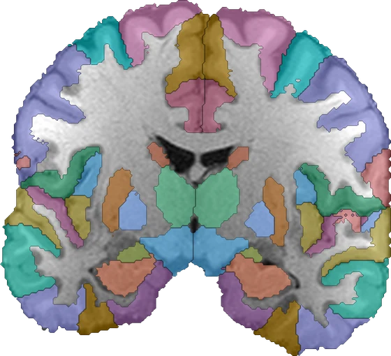 Coronal T1-weighted slice of one subject with the gray matter regions of the Neuromorphometrics atlas, mapped into the subject’s native space