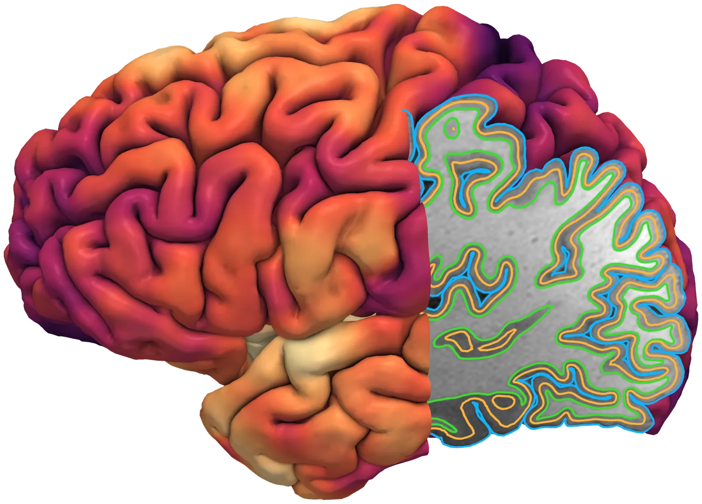 Cortical thickness in color on the left hemisphere. The back half is cut open along a sagittal T1-weighted slice that shows the pial, central and white matter surfaces reconstructed by CAT.