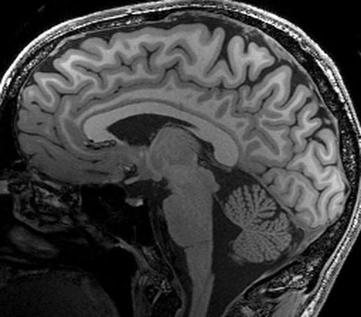 Sagittal T1-weighted MRI of one subject