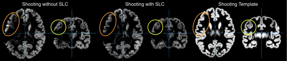 Shooting registration of a brain with a stroke lesion without and with stroke lesion correction (SLC), compared to the Shooting template; circles mark regions affected by the lesion